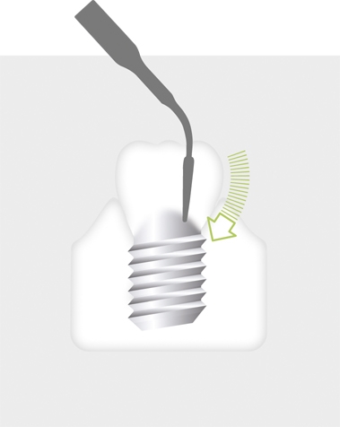 W&H Implantology Tip 1I W&H Implantology Tip 1I